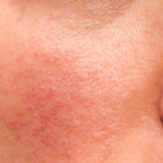 rote Äderchen (Anzeichen Rosacea)