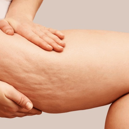 Cellulite Oberschenkel